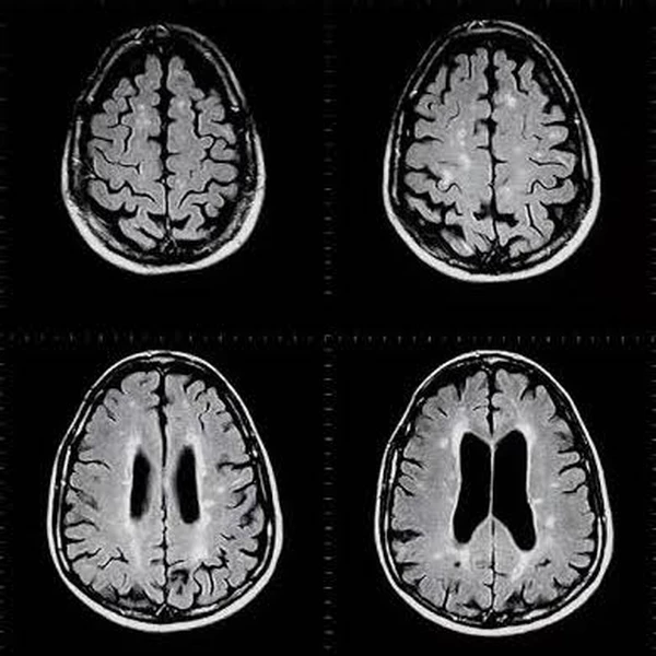 Epilepsy Brain Scan - Radiotherapy